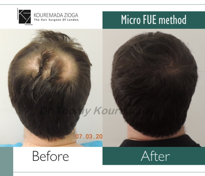 17.hair-transplant-micro-fue-dr kouremada-zioga