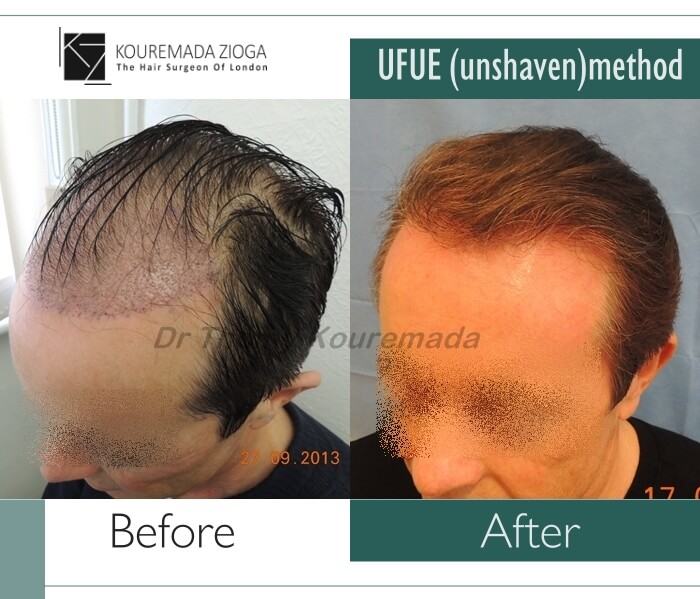 5.hair-transplant-unshaven-fue-dr kouremada-zioga