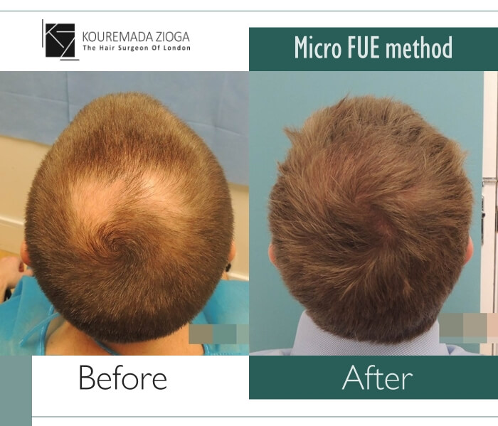 8.hair-transplant-micro-fue-dr kouremada-zioga
