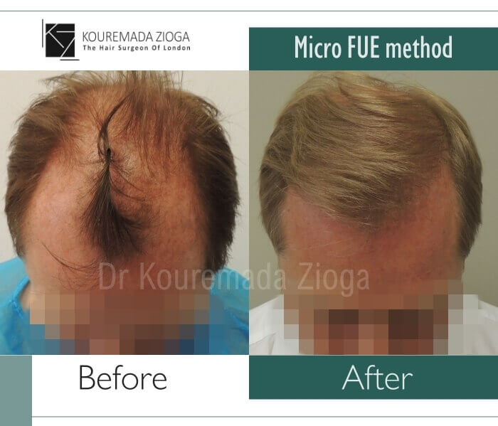 45 hair transplant micro fue dr kouremada zioga london