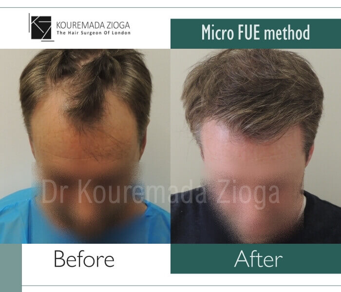 45 hair transplant micro fue dr kouremada zioga london